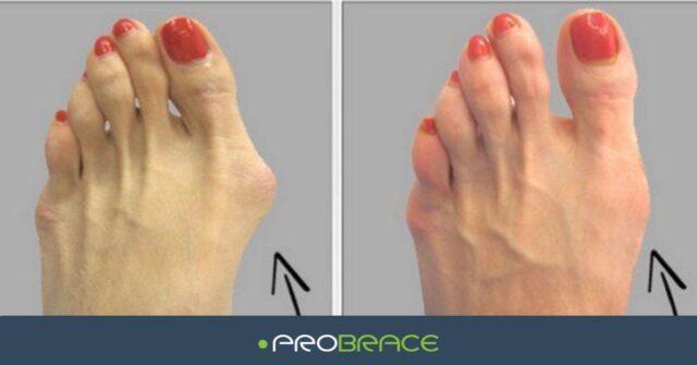 Hallux Valgus Scheefgroeiende Teen Bunion Nachtspalk Blog Informatie Probrace
