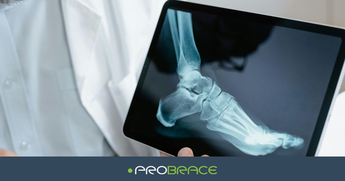 Enkel Instabiel Doorzakken Ondersteuning Brace Bandage Wandelen Sporten Probrace Behandeling