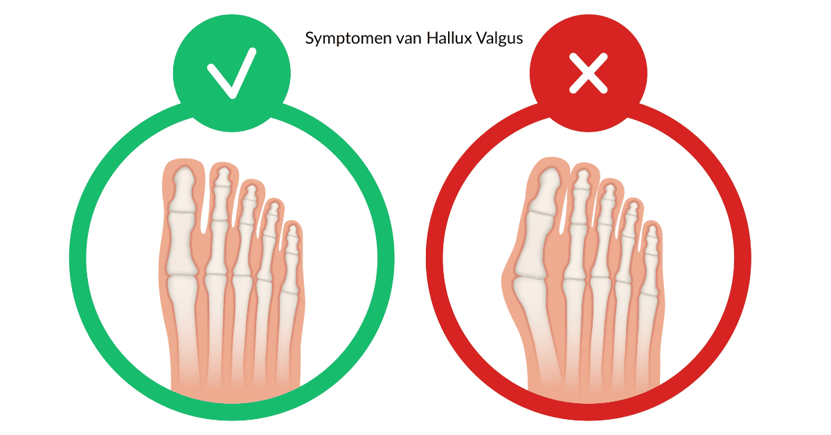 Symptomen Van Hallux Valgus Scheve Grote Teen